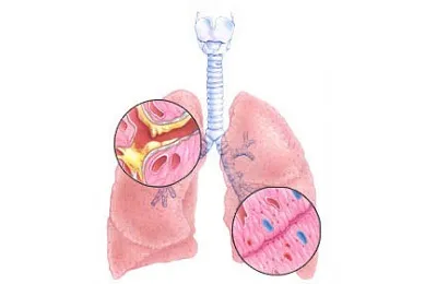 A krónikus obstruktív bronchitis kezelésére