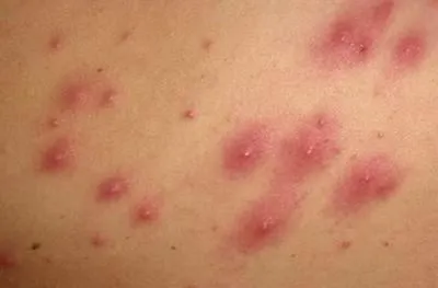 Ettől a pillanattól streptocid