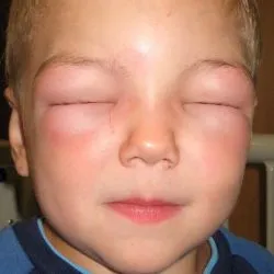 Allergiás okozza az arc, elsősegély és kezelés