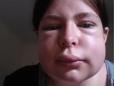 Allergiás duzzanat az arc, hogy miért van, tünetek és kezelés (fő) Allergiás duzzanat az arc, hogy miért van, tünetek és kezelés