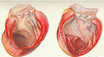 Aneurysmát pitvari septum aneurysma MPP, mi ez