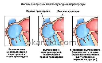 WFP aneurizma (pitvari septum) a felnőttek és gyermekek (gyermek) WFP aneurizma (pitvari septum) a felnőttek és gyermekek