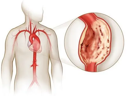 Pitvari septum aneurysma vagy aneurizma MPP -, hogy ez a felnőtteknél (felnőtt) Pitvari septum aneurysma vagy aneurizma MPP -, hogy ez a felnőtteknél