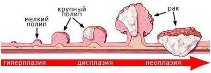 Antrum ahol osztályok, diagnosztika (antrális) Antrum ahol osztályok, diagnosztika