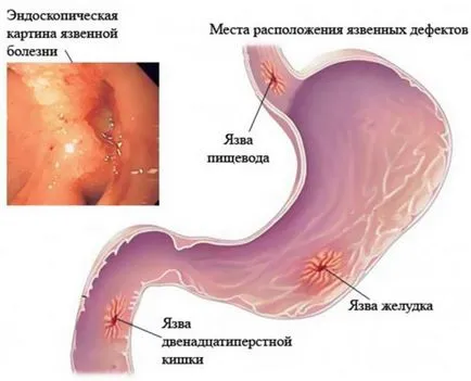 Antrum ahol osztályok, diagnosztika (is) Antrum ahol osztályok, diagnosztika