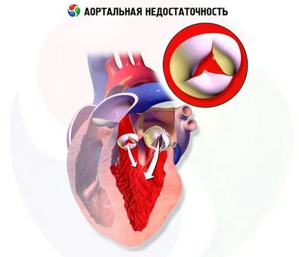 Aorta regurgitatio okoz, tünetei, diagnózisa, kezelése, az illetékes egészségügyi on iLive (öklendezés) Aorta regurgitatio okai, tünetei, diagnózisa, kezelése, az illetékes egészségügyi on iLive