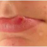Szemölcsök a lábon kiválasztani a legjobb kezelési lehetőség (opció) Szemölcsök a lábon kiválasztani a legjobb kezelési lehetőség