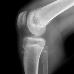 Osgood-Schlatter betegség - tünetek, kezelés, következményei (kezelés) Schlatter-Osgood betegség - tünetek, kezelés, következményei