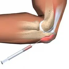 Bursitis a könyök okoz, a tünetek