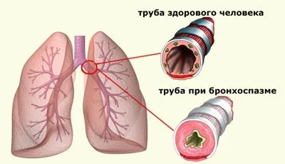 Bronchospasmus - okok, jelek, tünetek, és a kezelés (tünetek) Bronchospasmus - okok, tünetek, tünetei és kezelése