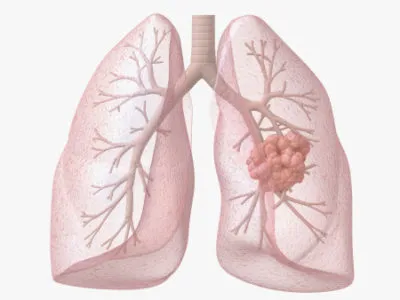 Bronchitis típusok, mint veszélyes szövődmény és milyen orvos kezel