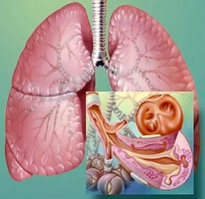 Bronchitis típusok, mint veszélyes szövődmény és milyen orvos kezel