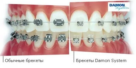 Melles Damon (tiszta, q, 3) előtti és utáni képek, árak, foglalás