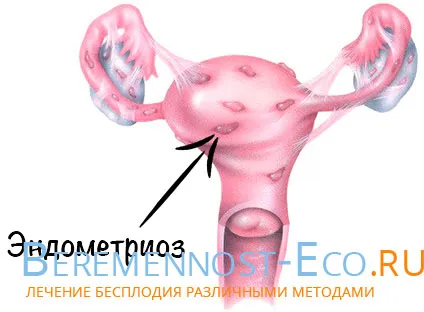 Hogy veszélyes endometriózis méh (veszélyes) Mennyire veszélyes a méh endometriosis