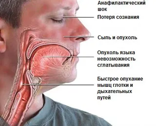 Mi a teendő abban az esetben az allergia az okozati összefüggés és a kezelés (oka) Mi a teendő, ha allergiás azonosítani az okok és kezelés