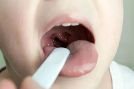 Mi van, ha az orr töltött fel vysmarkivaetsya és hogyan kell tisztítani a takony (eltávolítás orrdugulás) Mi van, ha az orr töltött fel vysmarkivaetsya és hogyan kell tisztítani a takony