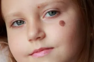 Mi a diszpláziás anyajegyet, típusok okai, kezelése