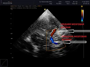 Mi ér Doppler ultrahang a nyak és a fej, mint csinálni, és ez azt mutatja, az agy ultrahang, és az ár (hajók) Mi ér Doppler ultrahang a nyak és a fej, mint csinálni, és ez azt mutatja, az agy ultrahang, az ár és