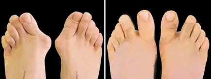 A deformáció a lábujjak, mint egy fix - valgus deformitás a nagylábujj, és nem tudta,
