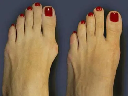 A deformáció a lábujjak, mint egy fix - valgus deformitás a nagylábujj, és nem tudta,