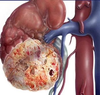 Nincs (vagy nem) MRI gyermek (ek) Nincs (vagy nem) MRI gyerekek