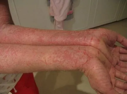 Dermatosis - formák, okok, tünetek (fotó), a kezelést (dermatosis) Dermatosis - formák, okok, tünetek (fotó), a kezelés