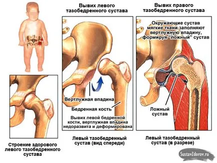 Csípőficam csecsemők okai, tünetei és kezelése