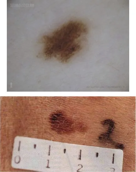 Diszpláziás anyajegyet pigment mikor és hogyan kell eltávolítani