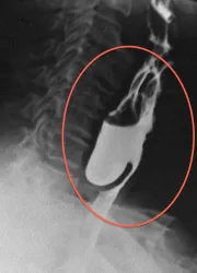 nyelőcső diverticulum