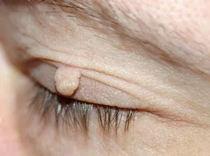 Skin fibroma mi ez, okainak kialakulása és kezelési módszerek