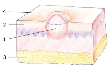 Skin fibróma - okai, tünetei és kezelése