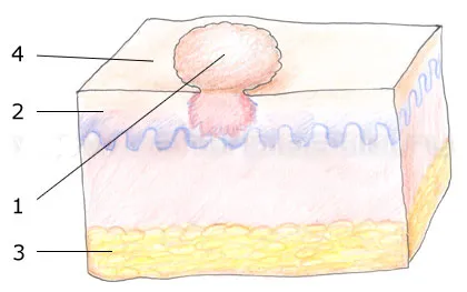 Skin fibróma - okai, tünetei és kezelése