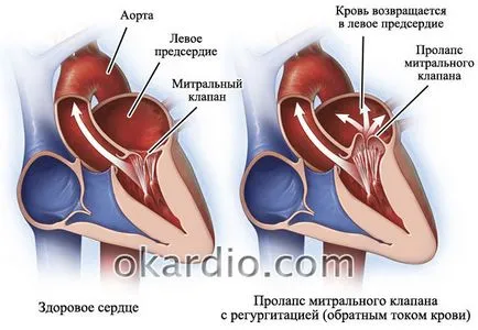 Pitvarfibrilláció tünetei, kezelése, és a prognózis formában (után szívsebészet) Pitvarfibrilláció tünetei, kezelése, és a prognózis formában