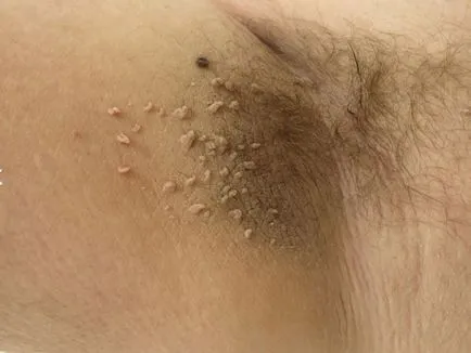 Skin fibroma mi ez, okainak kialakulása és kezelési módszerek