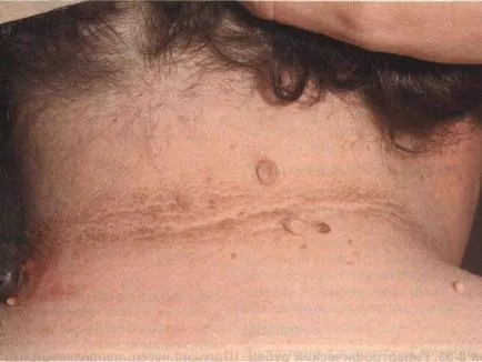 Skin fibroma mi ez, okainak kialakulása és kezelési módszerek