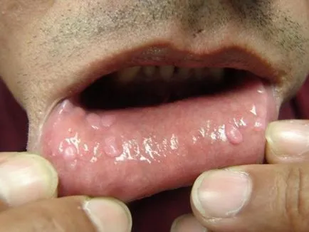 Skin fibroma mi ez, okainak kialakulása és kezelési módszerek