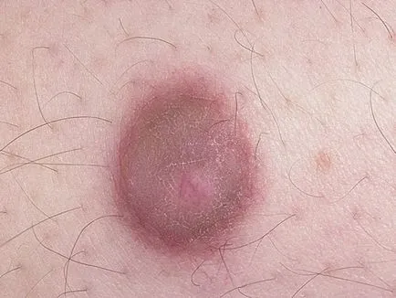 Skin fibroma mi ez, okainak kialakulása és kezelési módszerek
