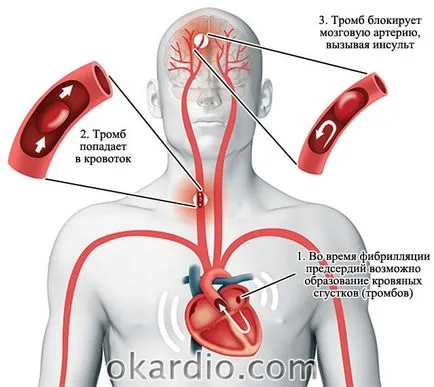 Pitvarfibrilláció tünetek, kezelés, prognózis, és a forma (a pitvar) Pitvarfibrilláció tünetei, kezelése, és a prognózis formában