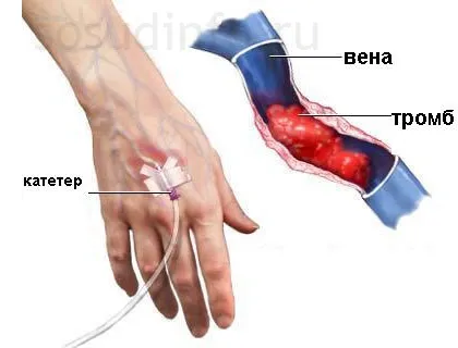 Phlebitis (vénagyulladás) kézzel és alsó végtagok a tünetek, a kezelés