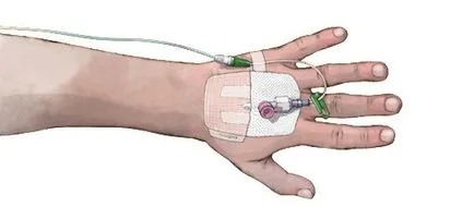Phlebitis (vénagyulladás) kézzel és alsó végtagok a tünetek, a kezelés