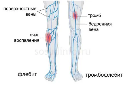 Phlebitis (vénagyulladás) kézzel és alsó végtagok a tünetek, a kezelés
