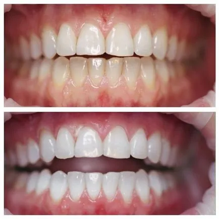 fotohalványításon fogak azaz előtti és utáni képek, beszámolók (foto-) fotohalványításon fogak azaz előtti és utáni képek, beszámolók