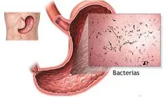 Gastroenteritis - Kezelés, tünetei, okai