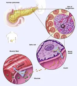 Hyperinsulinaemia okok, tünetek és a kezelés