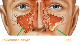 Az orrmelléküreg-gyulladás tünetei, okai és kezelése sinusitis