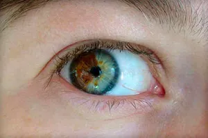 Szem különböző színű (heterochromia), az azt jelenti, hogy az okok raznoglaziya (fotó)
