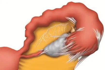 Hydrosalpinx jog 1