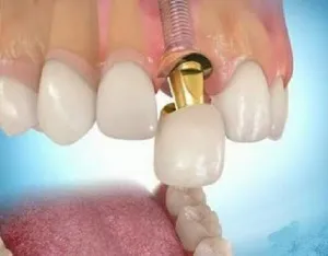 Mi jobb, ha koronák implantátumokra, felülvizsgálatát árak és vélemények