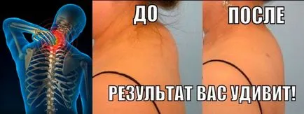 Hogyan lehet megszabadulni a mar a nyakát hátulról, otthon