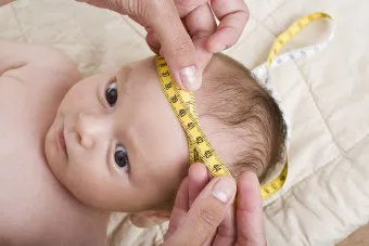 Ahogy kezelt terjeszkedés convexital subarachnoidealis térben (kiterjesztési convexital subarachnoidalis térben) Mivel a bővítő kezelt subarachnoidális térben convexital
